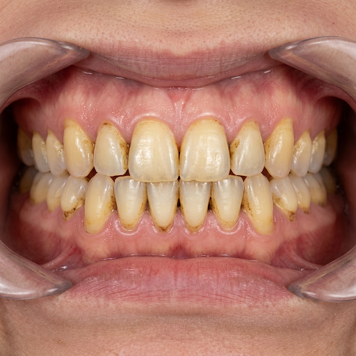 Before teeth whitening
